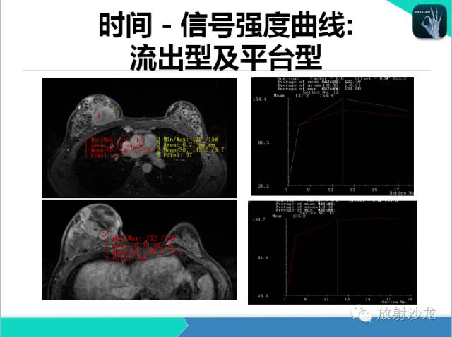 【PPT】乳腺病变的MR诊断