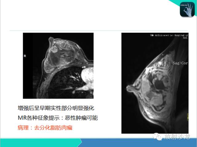 【PPT】乳腺病变的MR诊断