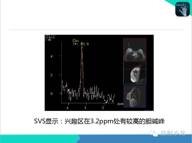 【PPT】乳腺病变的MR诊断