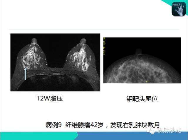【PPT】乳腺病变的MR诊断