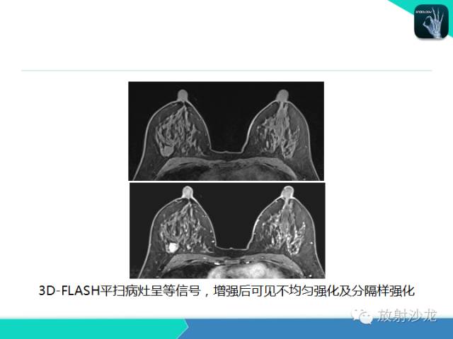 【PPT】乳腺病变的MR诊断