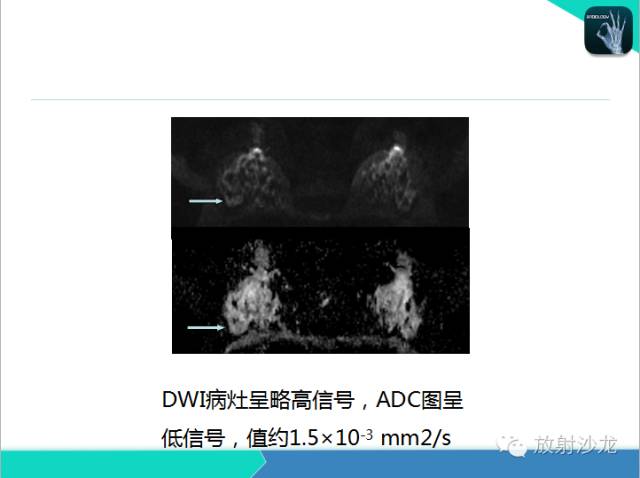 【PPT】乳腺病变的MR诊断