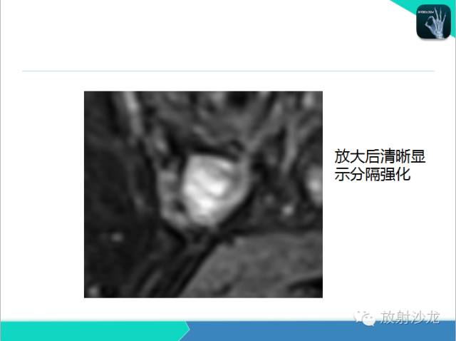 【PPT】乳腺病变的MR诊断