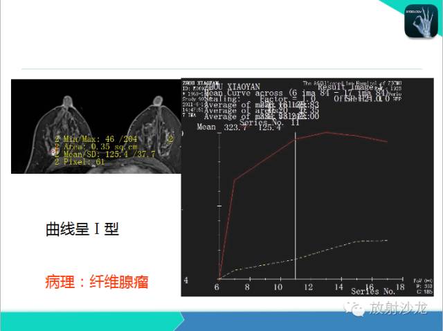 【PPT】乳腺病变的MR诊断