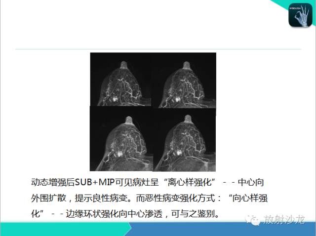 【PPT】乳腺病变的MR诊断