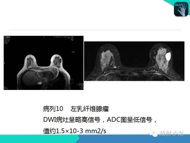 【PPT】乳腺病变的MR诊断