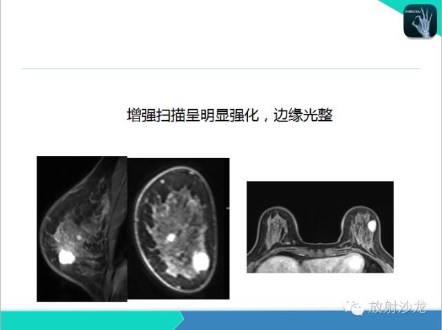 【PPT】乳腺病变的MR诊断