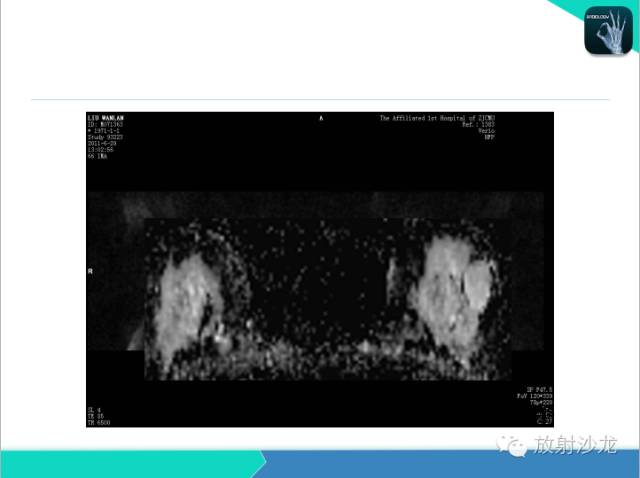 【PPT】乳腺病变的MR诊断