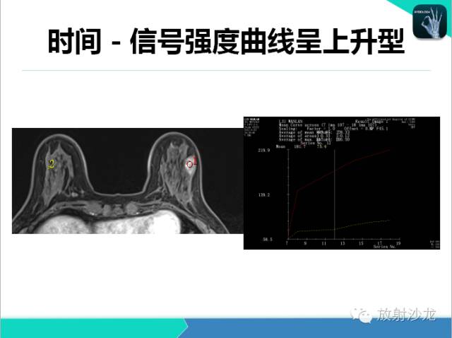 【PPT】乳腺病变的MR诊断