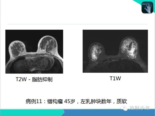 【PPT】乳腺病变的MR诊断