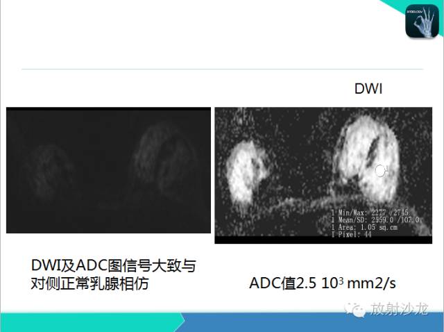 【PPT】乳腺病变的MR诊断