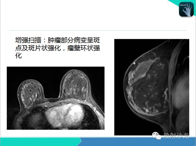 【PPT】乳腺病变的MR诊断