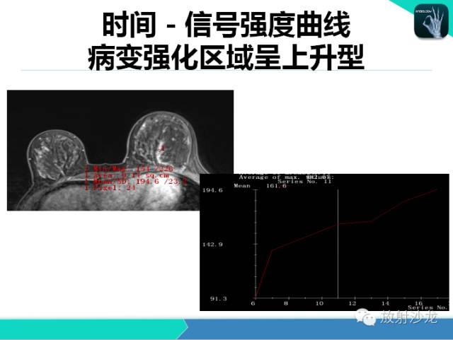 【PPT】乳腺病变的MR诊断