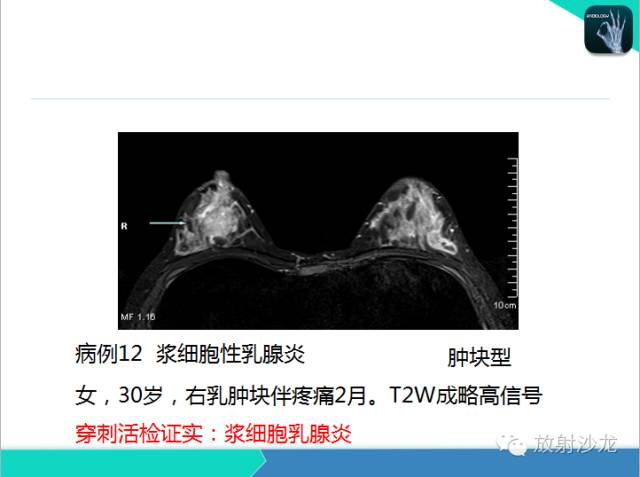 【PPT】乳腺病变的MR诊断