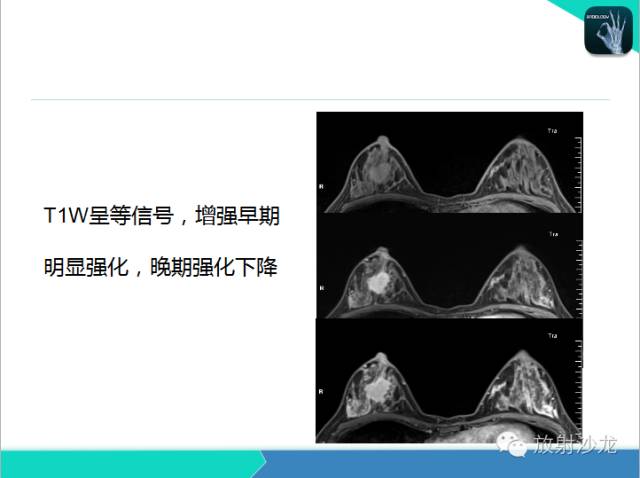 【PPT】乳腺病变的MR诊断