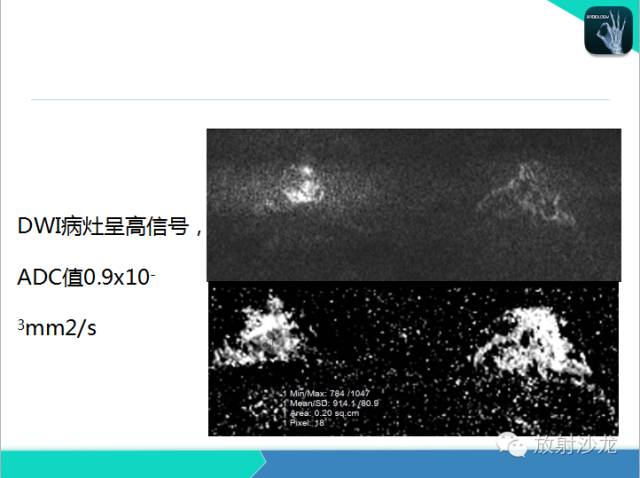 【PPT】乳腺病变的MR诊断