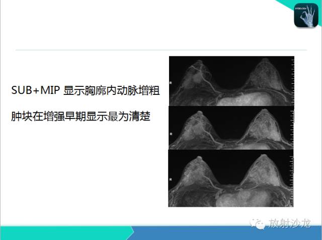 【PPT】乳腺病变的MR诊断