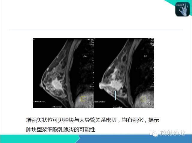 【PPT】乳腺病变的MR诊断
