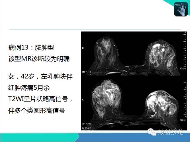 【PPT】乳腺病变的MR诊断