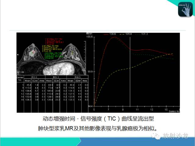 【PPT】乳腺病变的MR诊断