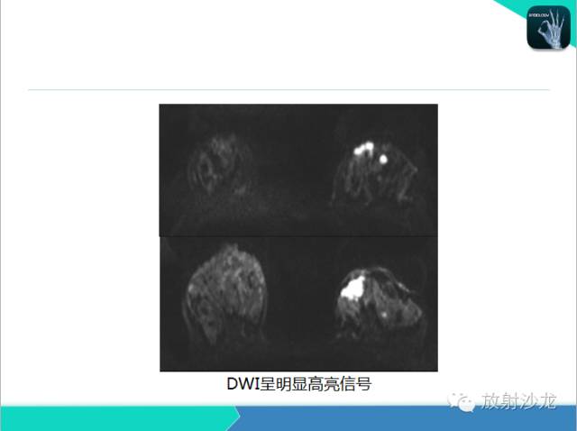 【PPT】乳腺病变的MR诊断