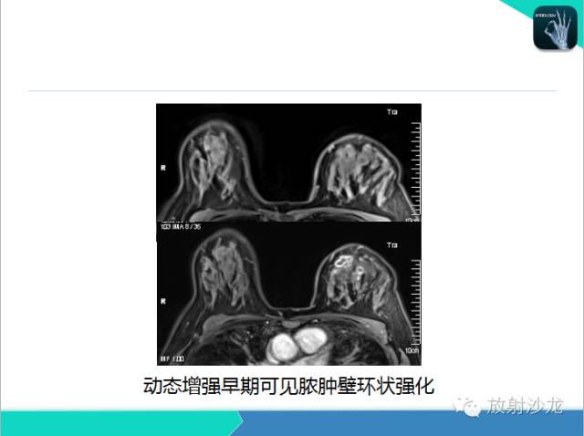 【PPT】乳腺病变的MR诊断