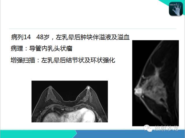 【PPT】乳腺病变的MR诊断