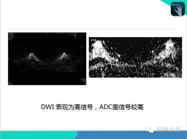 【PPT】乳腺病变的MR诊断