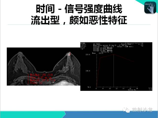 【PPT】乳腺病变的MR诊断