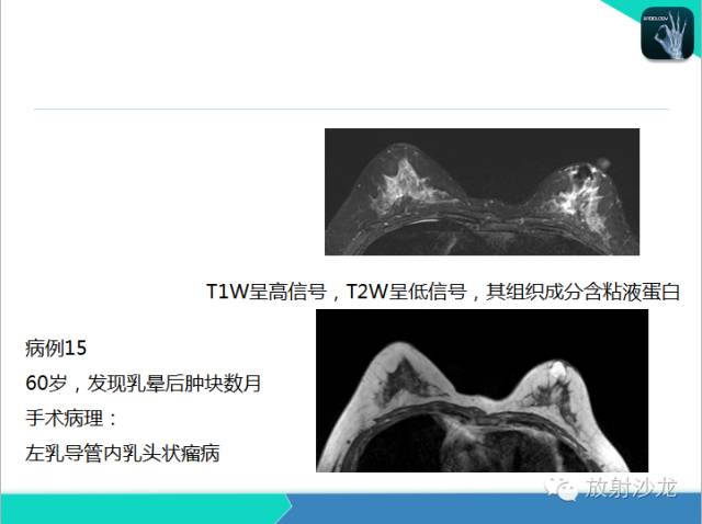 【PPT】乳腺病变的MR诊断