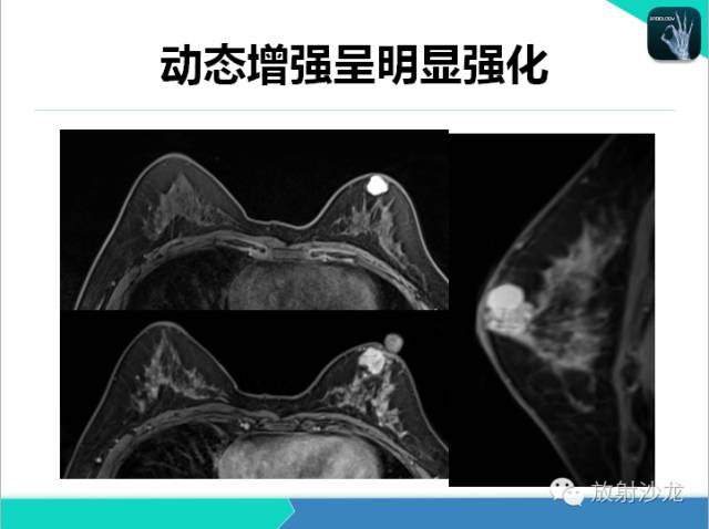 【PPT】乳腺病变的MR诊断