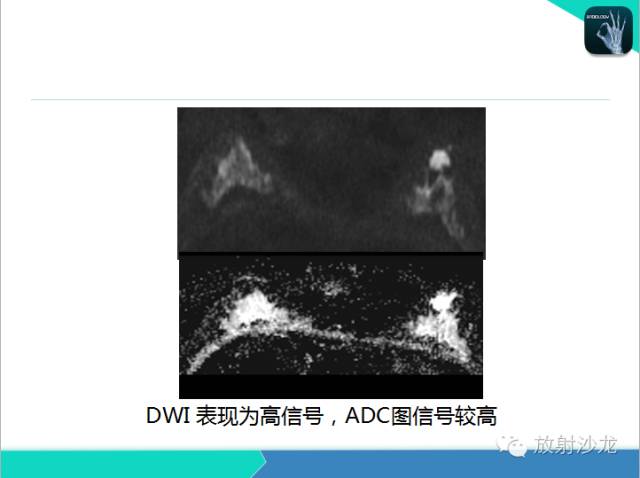 【PPT】乳腺病变的MR诊断