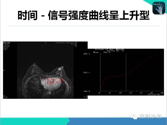 【PPT】乳腺病变的MR诊断