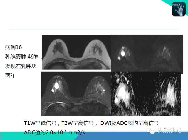 【PPT】乳腺病变的MR诊断