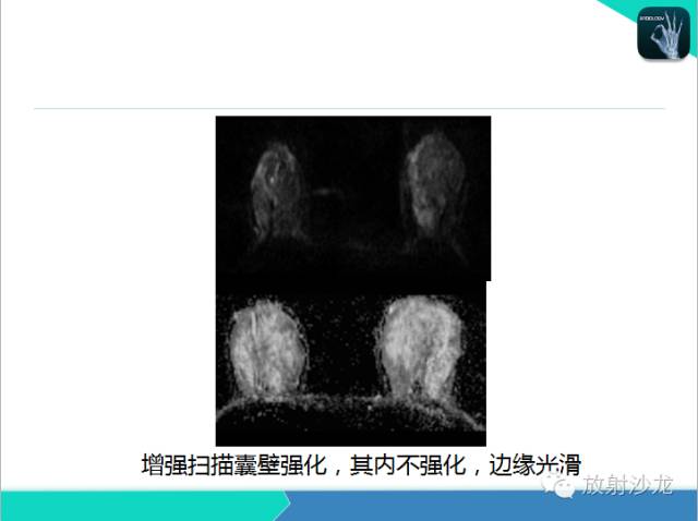 【PPT】乳腺病变的MR诊断