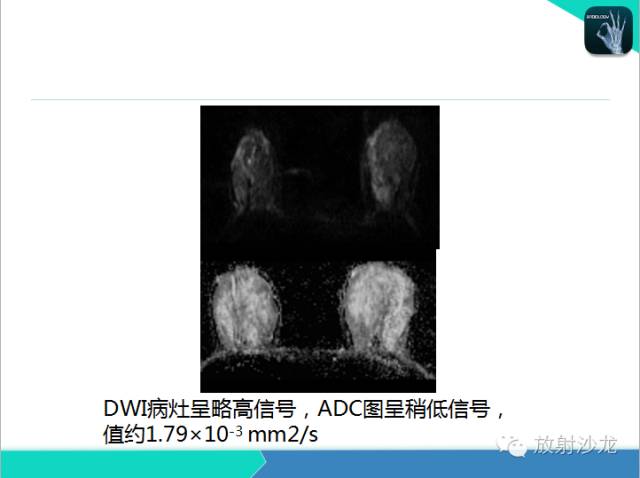 【PPT】乳腺病变的MR诊断
