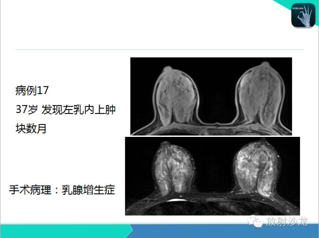 【PPT】乳腺病变的MR诊断