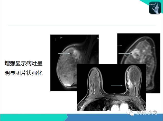【PPT】乳腺病变的MR诊断