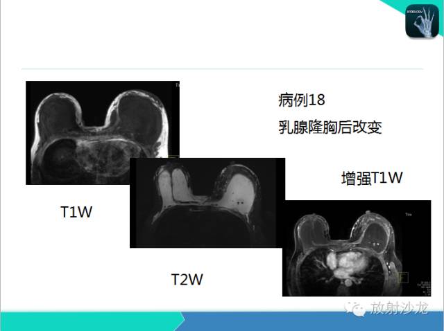 【PPT】乳腺病变的MR诊断
