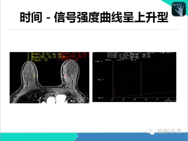 【PPT】乳腺病变的MR诊断