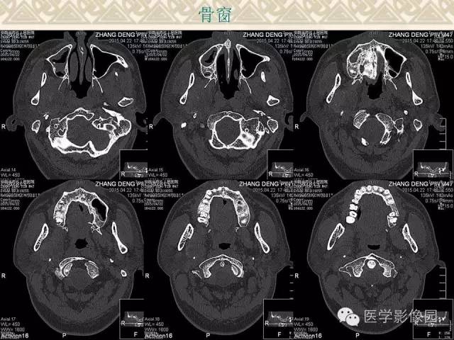 【病例】颅底软骨母细胞瘤1例CT影像表现 【病例】颅底软骨母细胞瘤1例CT影像表现