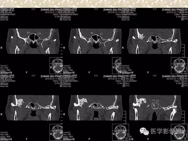 【病例】颅底软骨母细胞瘤1例CT影像表现 【病例】颅底软骨母细胞瘤1例CT影像表现