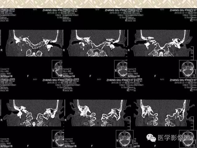 【病例】颅底软骨母细胞瘤1例CT影像表现 【病例】颅底软骨母细胞瘤1例CT影像表现