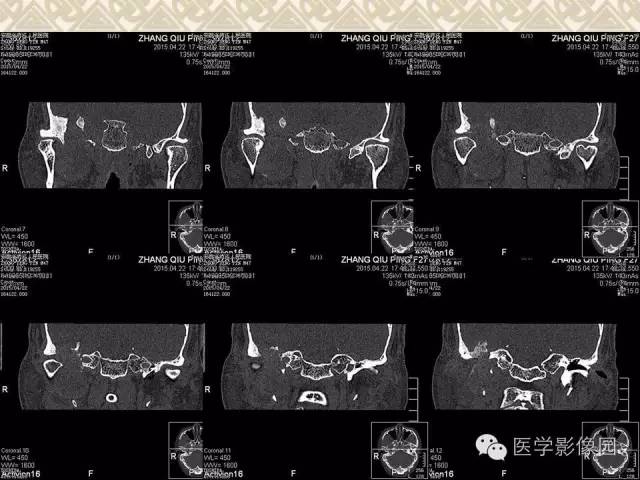 【病例】颅底软骨母细胞瘤1例CT影像表现 【病例】颅底软骨母细胞瘤1例CT影像表现