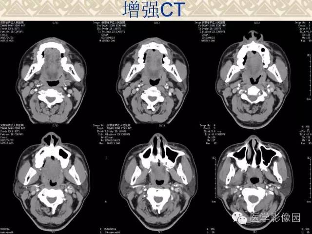 【病例】颅底软骨母细胞瘤1例CT影像表现 【病例】颅底软骨母细胞瘤1例CT影像表现