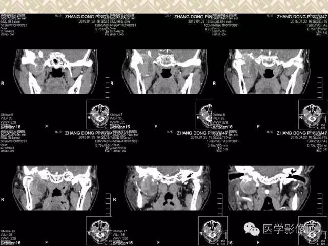 【病例】颅底软骨母细胞瘤1例CT影像表现 【病例】颅底软骨母细胞瘤1例CT影像表现