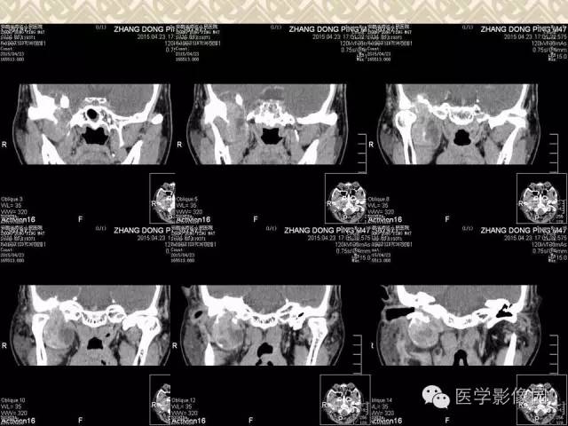 【病例】颅底软骨母细胞瘤1例CT影像表现 【病例】颅底软骨母细胞瘤1例CT影像表现