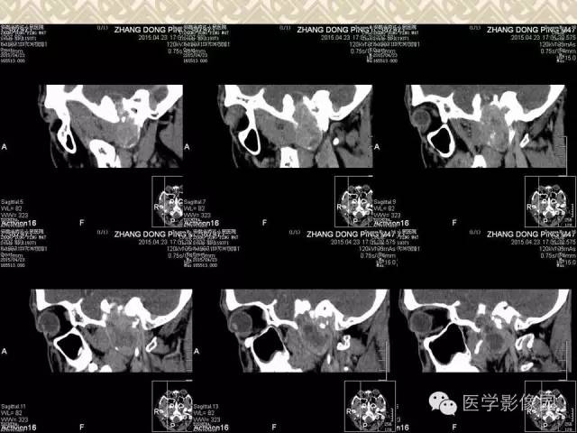 【病例】颅底软骨母细胞瘤1例CT影像表现 【病例】颅底软骨母细胞瘤1例CT影像表现