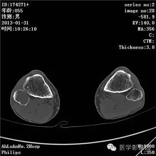 【病例】腓骨骨巨细胞瘤1例CT影像表现 【病例】腓骨骨巨细胞瘤1例CT影像表现