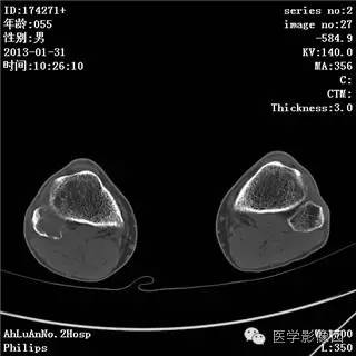 【病例】腓骨骨巨细胞瘤1例CT影像表现